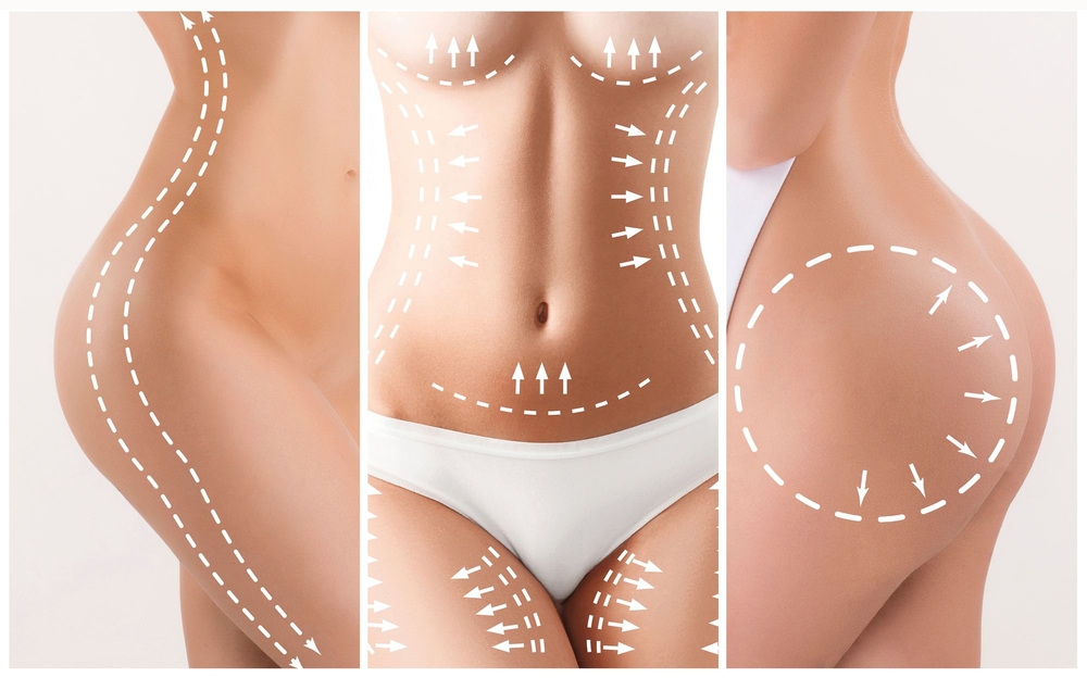 Liposuction Montreal - Liposuction Costs in Montreal